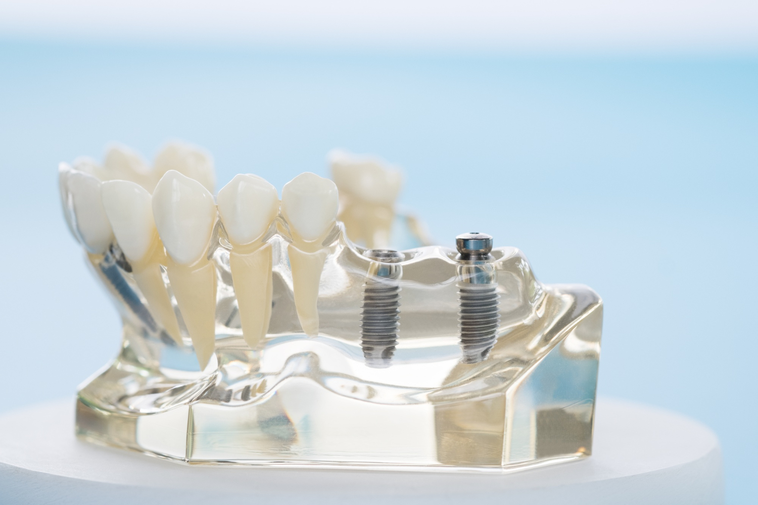 dental implants
